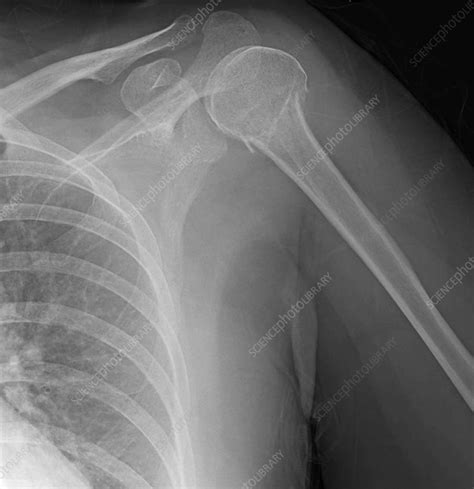 Humerus fracture, X-ray - Stock Image - F036/0236 - Science Photo Library