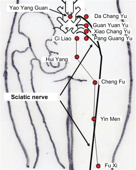 Acupuncture For Sciatica - SELF DEVELOPMENT INSTITUTE