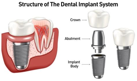 Different Kinds of Dental Implants - Larchmont Dental Associates