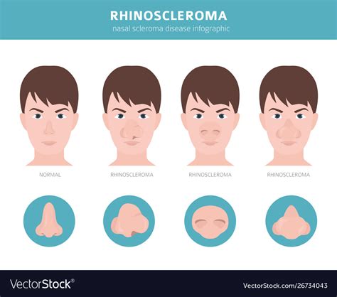 Nasal diseases rhinoscleroma symptoms Royalty Free Vector