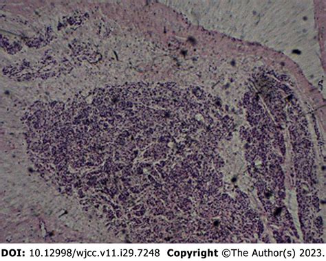 Thyroglossal Duct Cyst Histology