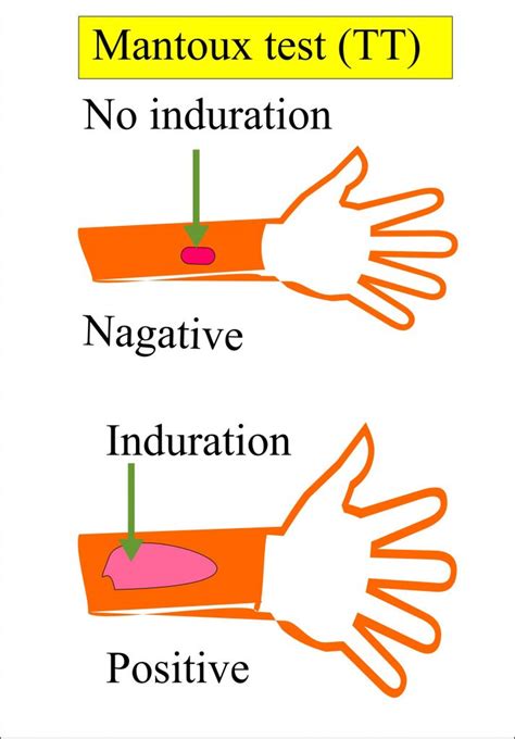 Mycobacterium Tuberculosis - Part 1 - Diagnosis of Pulmonary Tuberculosis (TB), Mantoux Test ...