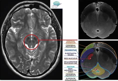 Brainstem Anatomy Mri