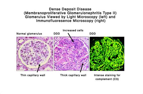 Membranoproliferative Glomerulonephritis