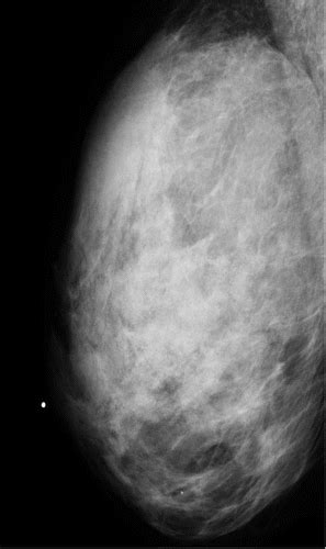 What Is Fibroglandular Density