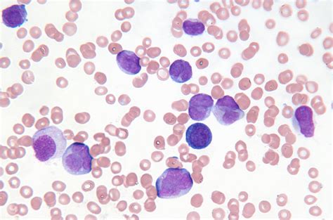 White Blood Cells May Play Role In Spread Of Cancer | HuffPost