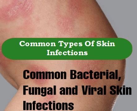 Bacterial, Fungal & Viral Skin Infections: Common Signs & Symptoms ...