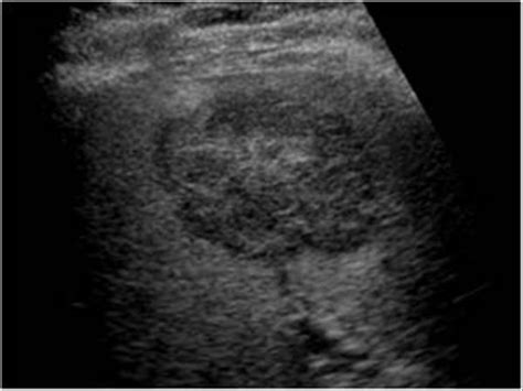 Abdomen and retroperitoneum | 1.1 Liver : Case 1.1.1 Focal nodular hyperplasia and hepatic ...