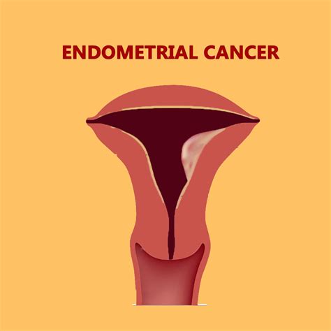 Best Cancer Hospital in India | Endometrial Cancer Treatment in Coimbatore | Tamil Nadu