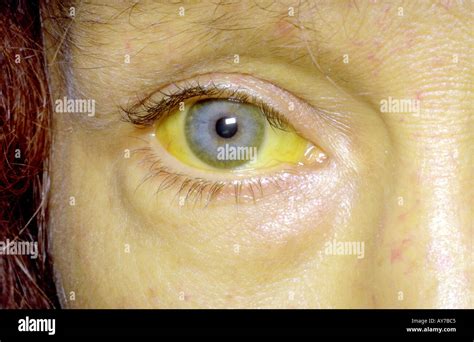 Jaundice alcoholic liver disease Stock Photo: 1801156 - Alamy