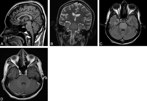 MR imaging revealed a pontine lesion occupying almost the entire pons,... | Download Scientific ...