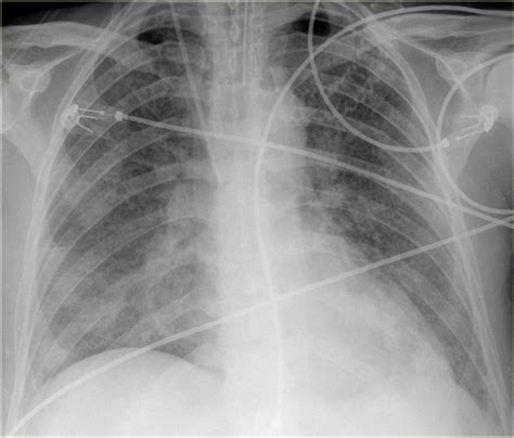 Pulmonary Edema Vs Normal Chest X Ray