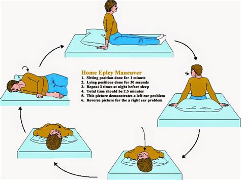 Printable Epley Maneuver Patient Handout