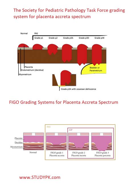 SPP and FIGO Grading Systems for Placenta Accreta Spectrum - medicalkidunya