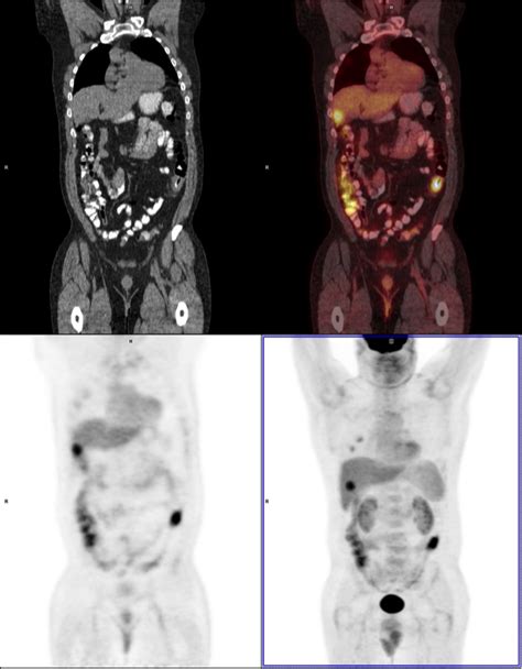 Colon Cancer and Liver Metastasis | NucsRadiology.com