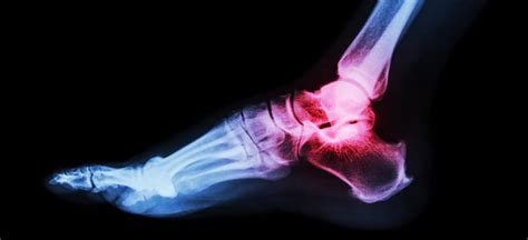 Broken Ankle Surgery, Treatment and Recovery | Crutches After Ankle Surgery