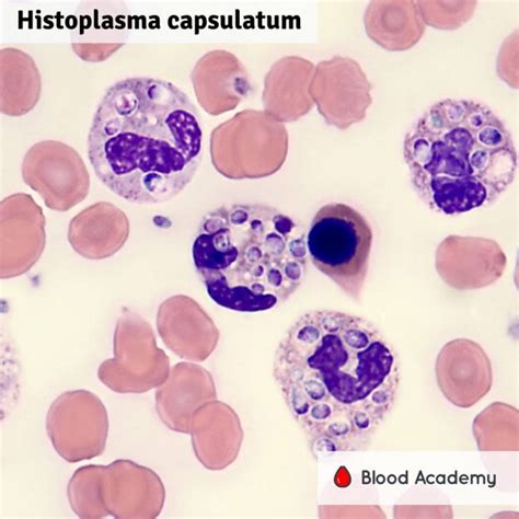 Histoplasma capsulatum - Blood Academy