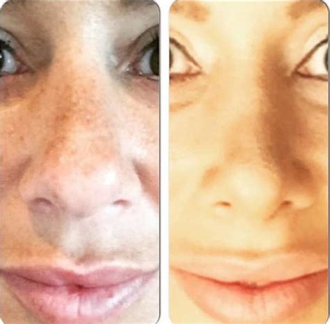 Deviated Septum Before And After (11) » Rhinoplasty: Cost, Pics ...