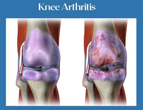 Can you regrow knee cartilage? YES - In just minutes a day — nickengerer.org