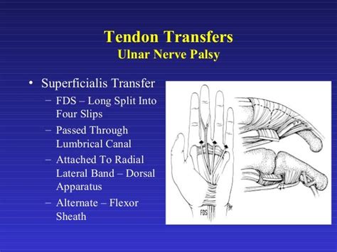 12. tendon transfers