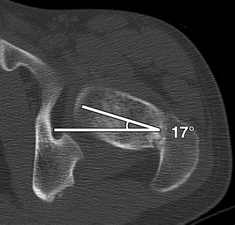 Axial Oblique CT to Assess Femoral Anteversion | AJR