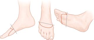 Transmetatarsal Amputation | New Health Advisor