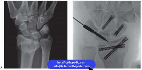 RADIAL STYLOID FRACTURES