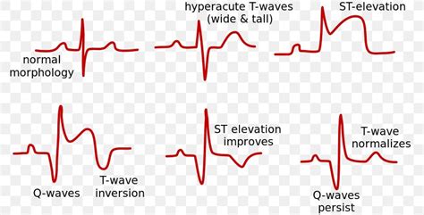 ST Elevation Acute Myocardial Infarction ST Segment Elevation Myocardial Infarction ...