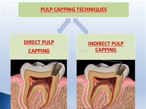 Pulp capping