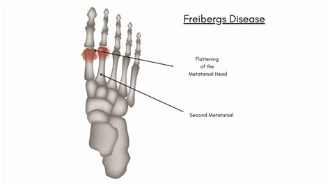 Freiberg Disease: Learn How to Treat Freiberg's Disease