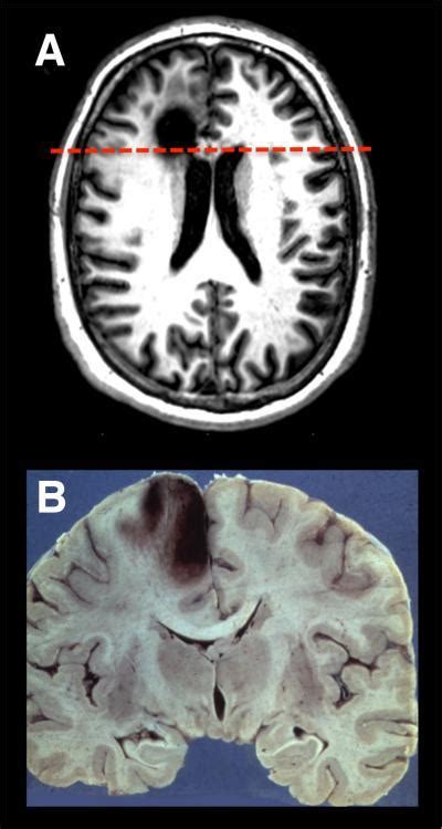 Studying Prefrontal Lobe Damage Unlocks Brain Mysteries | Science 2.0