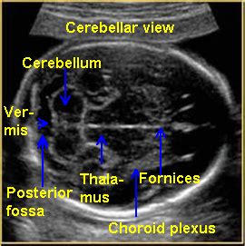 Fetal Brain Ultrasound Labeled