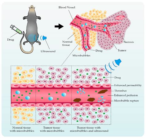 Ultrasonic Microbubble Cavitation in Tumor Therapy | Encyclopedia MDPI