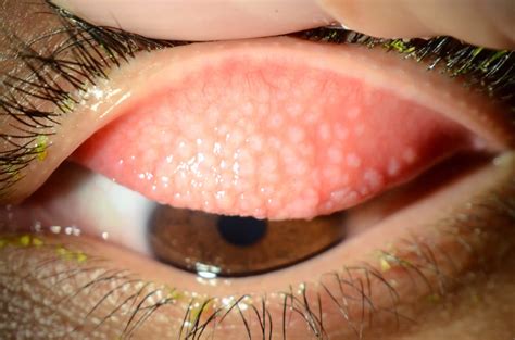 Giant Papillary Conjunctivitis | Wills Eye Hospital