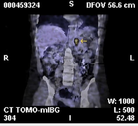 I-123 MIBG scan of the patient with an increased uptake in the left... | Download Scientific Diagram