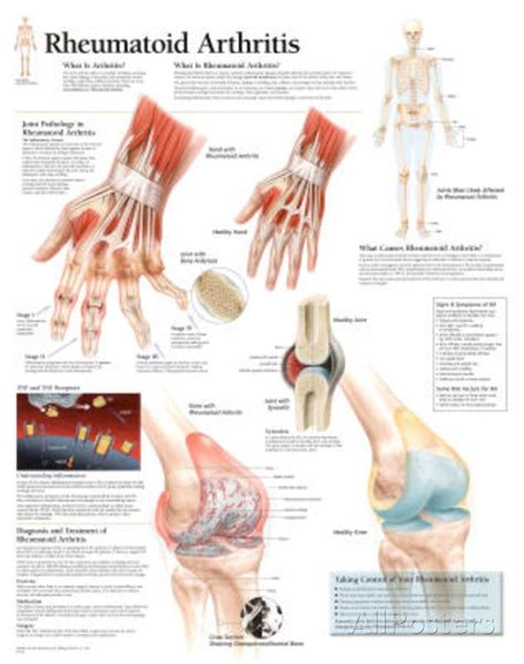 53 best Rheumatoid Arthritis images on Pinterest | Health, Rheumatoid ...