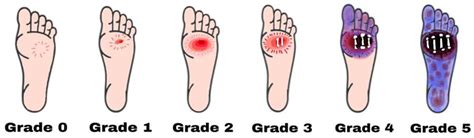 Diabetic Foot Ulcer Stages