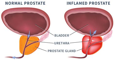 A Better Path to Diagnosing Prostatitis - Sperling Prostate Center