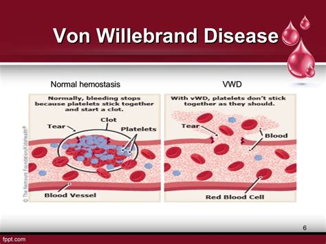 Von Willebrand Disease