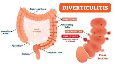 5 Symptoms of Diverticulosis – Entirely Health