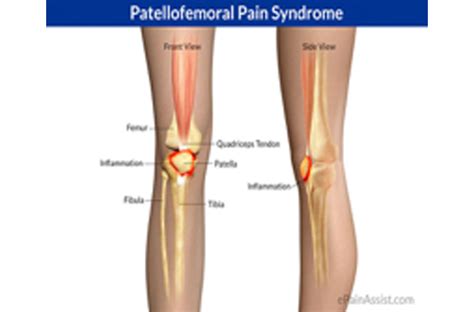 Patellar Overload Syndrome (Chondromalacia Patella)