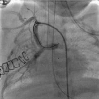 Case 2 – Blalock–Taussig shunt occlusion. Antero-posterior incidence ...