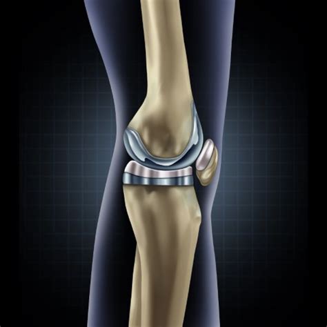 5 Things To Know About Robotic Knee Replacement Surgery | Add More to Life - Meril