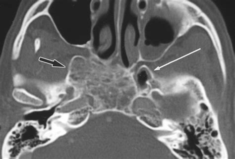 Fibrous Dysplasia Involving the Base of the Skull | AJR