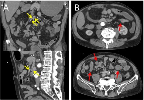 Contrasted-enhanced CT A: Occlusion of the SMA associated with a ...