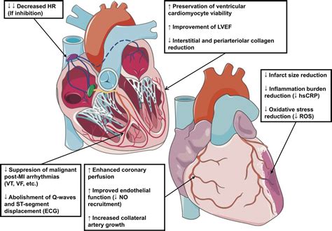 Role of ivabradine in management of stable angina in patients with different clinical profiles ...