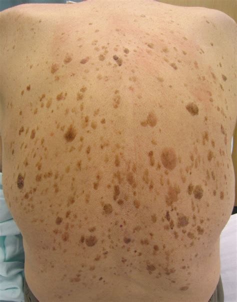 Seborrheic Keratosis or Old Age Spots | by Stephen Sovie | Your Voice ...