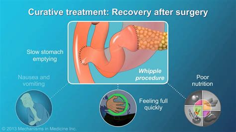 Pancreatic Cancer: Treatment and Outcomes - YouTube