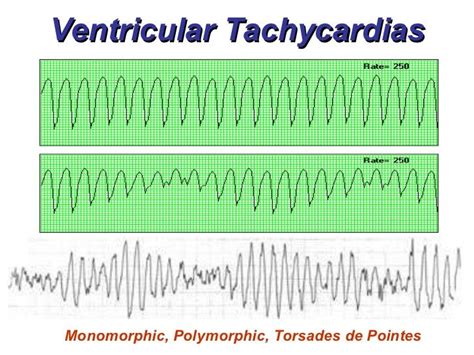 Image result for monomorphic ventricular tachycardia vs polymorphic | Ventricular tachycardia ...