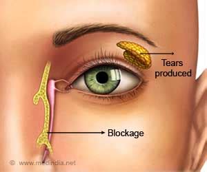 Blocked Tear Duct - Causes - Symptoms - Diagnosis - Treatment - FAQs